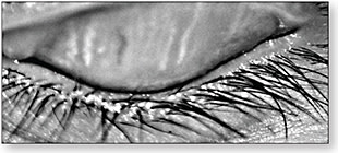 Figure 2. Only five to six partially atrophied glands remain in the upper lid.