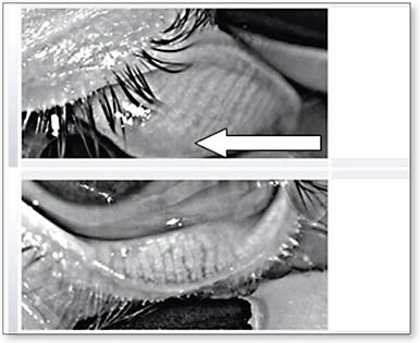 Figure 2. Meibomian gland dropout in the superior tarsus of a 38-year-old patient who has mixed blepharitis and dry eye.