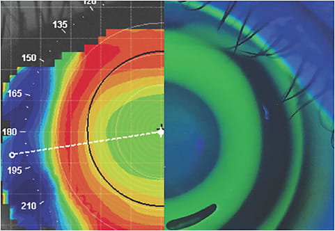 Topography and fluorescein pattern of a successful ortho-k fit.