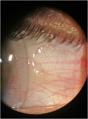 Figure 7. Final scleral lens upon application.