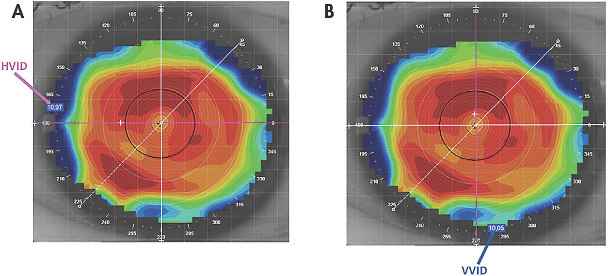 Figure 1. Corneal maps showing different values in the horizontal and vertical meridians: horizontal visible iris diameter (HVID, 10.97mm) (A) and vertical visible iris diameter (VVID, 10.05mm) (B).