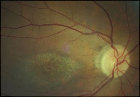 Figure 1. Perifoveal degerative changes in hydroxychloroquine macular toxicity.