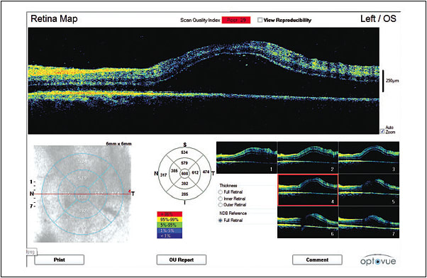 Figure 1. A patient who has macular edema, contributing to poor vision.