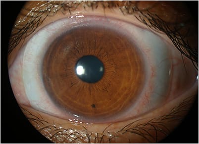 Figure 8A. Frontal view of new scleral lens OS in January 2022.