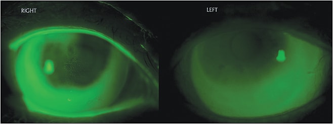 Figure 5. A keratoconus patient fit with scleral contact lenses.