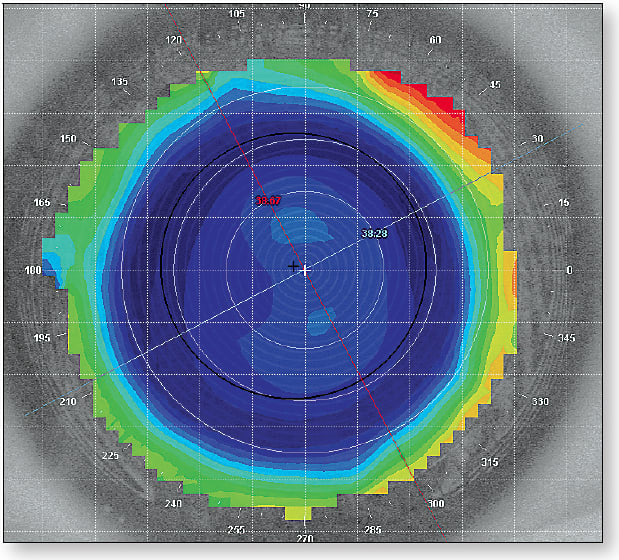 Figure 4. Hybrid lens. Residual Astigmatism: 0.39D