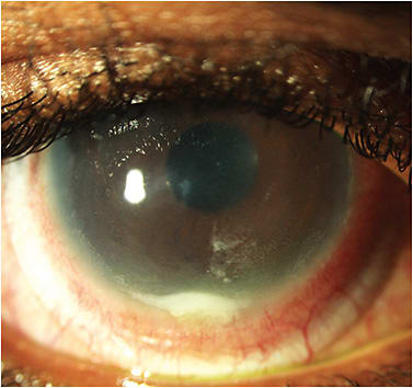 Figure 8. Inflammatory post-lens debris.