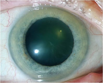 Figure 2. Same right eye as Figure 1 without scleral lens showing no signs of hypoxia-related stress following 10.5 years of full-time scleral lens wear.
Images courtesy of Karen G. Carrasquillo, OD, PhD