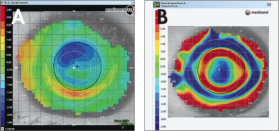 Figure 6. (A) Axial difference map showing the amount of treatment at the apex after one night of lens wear. (B) Tangential difference map showing centration of the lens after one night of lens wear.