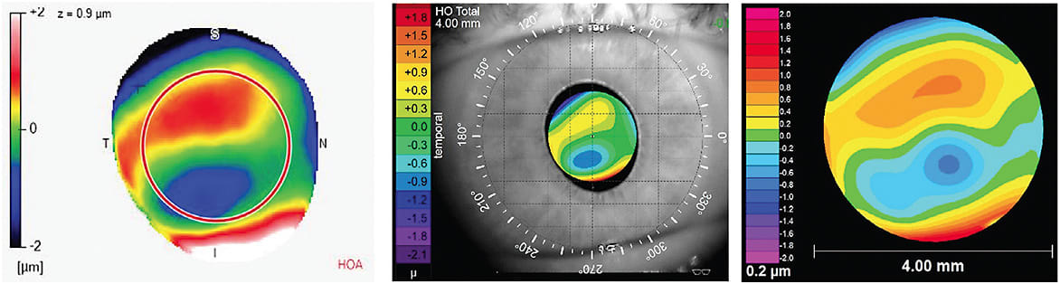 Figure 5. Wavefront aberration maps measured with three different aberrometers on an individual who has keratoconus. Although each instrument utilizes a slightly different scale, all three images demonstrate a prominent coma pattern typically found in keratoconus.