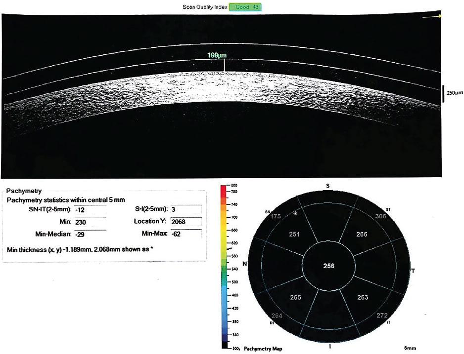 Figure 1. An OCT image showing the size of the vault between a patient’s cornea and contact lens.