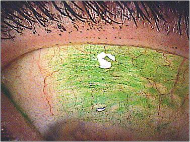 Figure 1. Superior limbic keratoconjunctivitis.&#xD;&#xA;Courtesy of William Townsend, OD