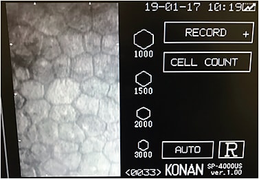 Figure 12. Careful evaluation of the endothelium through specular microscopy is valuable in monitoring the corneal response in both corneal and scleral GP lens wearers as well as in soft contact lens wear.