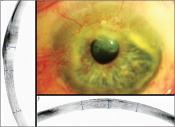 Figure 1. Slit lamp appearance of the patient&#x2019;s left eye post-pepper spray injury.