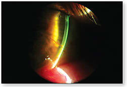 Figure 1. Neovascularization within RK incisions.