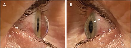 Figure 1. (A) Right eye with keratoglobus; (B) Left eye with keratoconus.