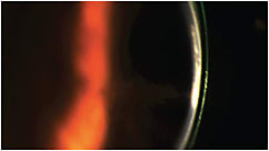 Figure 3. Insufficient corneal clearance with a scleral lens OS.