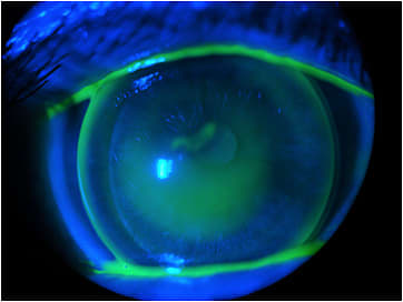 Figure 11. Minor apical touch OD.