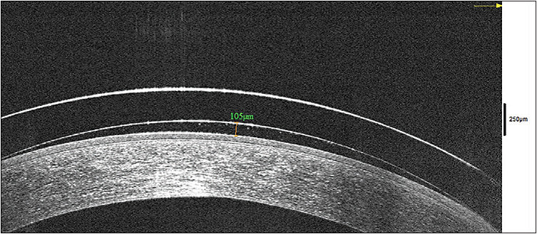 Figure 5. Optimal 100-micron central clearance of a hybrid lens shown on anterior segment optical coherence tomography. A caliper bar indicates the vault above the corneal surface after 20 minutes of settling time.