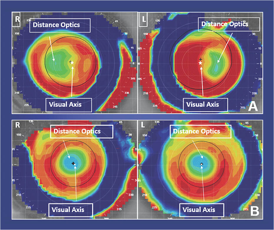 Figure 1. Offset multifocal optics.