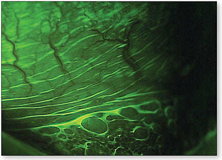 Figure 1. Inferior palpebral follicles evident with sodium fluorescein and a Wratten filter.