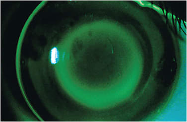 Figure 2. Orthokeratology lenses for myopia management should center and move well in addition to having adequate clearance under the peripheral zone to maintain good tear exchange.