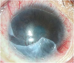 Figure 1. Corneal vascularization from 3 o’clock to 11 o’clock and inferior keratinization.