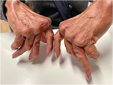 FIGURE 9. Deformity in joints of hands and fingers due to rheumatoid arthritis. Photo courtesy of Gloria Chiu, OD.