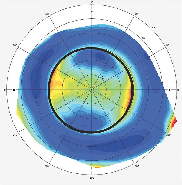 Figure 2. The patient’s left eye corneoscleral elevation map showing paralimbal toricity of the cornea but a spherical scleral surface.
