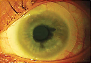 Figure 2. The 14.0mm diagnostic lens on the patient’s left eye.