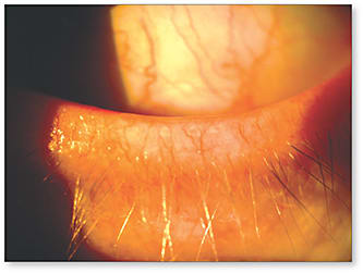 Figure 1. Dry eye is a challenge when fitting presbyopes. Meibomian gland dropout and eyelid irregularity increase with age, contributing to tear film instability