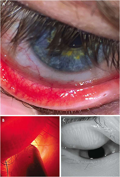 Figure 1. Practitioners can observe meibomian glands via direct visualization (A), eyelid transillumination (B), or infrared imaging (C).