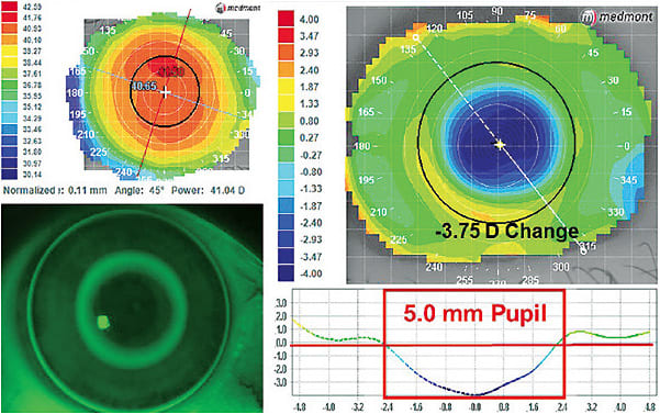 Figure 1. Axial subtractive display pre- and post-OK. Note the &#x2013;3.75D of apical power and the increasing plus power across the pupil.