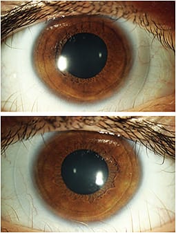 Figure 2. Custom soft toric lens fit OD (top) and OS (bottom) in Case 1 patient demonstrating ideal coverage, good centration, and minimal rotation.