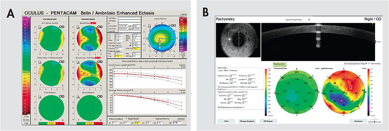 Figure 2. (A) OD: Normal Scheimpflug tomography. (B) OD: Abnormal epithelial thickness map (obtained by anterior segment optical coherence tomography) showing apical thinning of the epithelium inferior temporally with moderately elevated epithelial thickness variation.