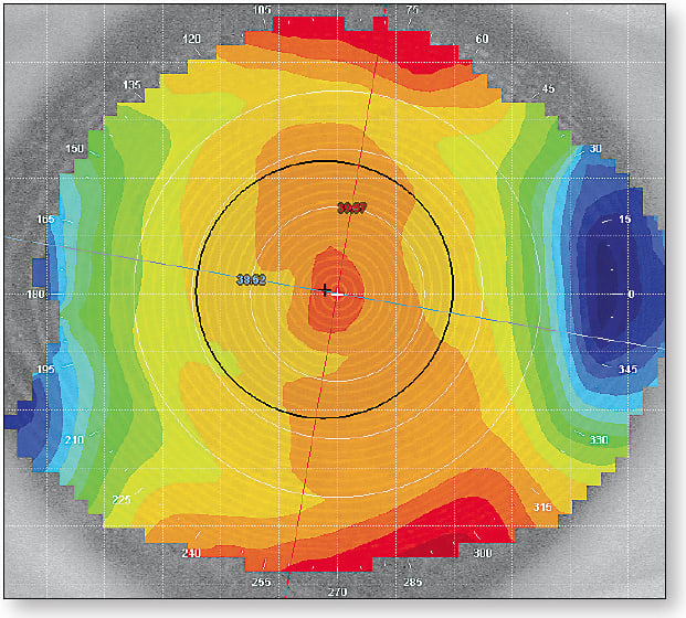 Figure 3. Monthly replacement lens. Residual Astigmatism: 1.04D