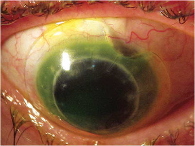 Figure 2. Scleral lens with a notch. Image courtesy of Greg DeNaeyer, OD