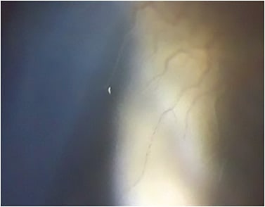 Figure 3. Corneal vascularization during extended soft lens wear.