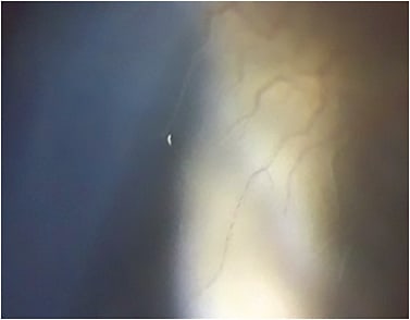 Figure 3. Corneal vascularization during extended soft lens wear.