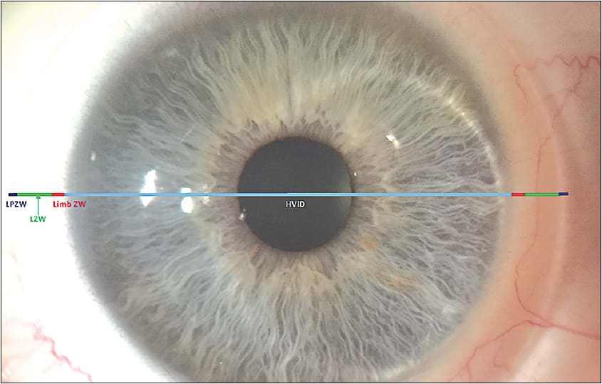 Figure 1. A scleral lens fit divided into the different zones that compose its TD: HVID, limbal zone width (Limb ZW), LZ width (LZW), and last peripheral zone width (LPZW).