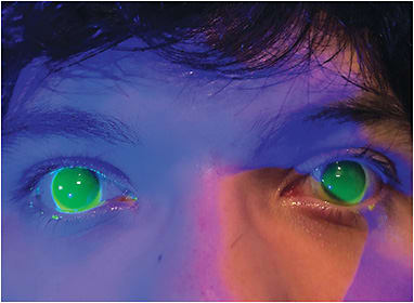 Figure 1. Specialty contact lenses can be fitted in pediatric patients for myopia management. Oblate scleral lenses can be designed for these patients to decrease the high-minus lens prescription.