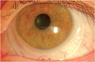 Figure 1. A 16.5mm free-form scleral lens.