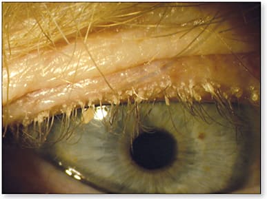 Figure 4. Demodex blepharitis.