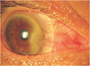 Figure 16. Free-form 16.5mm scleral lens for the Case 3 patient’s right eye.