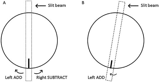 Figure 3. If the lens rotates to the left, add the amount of rotation to the refractive axis; if the lens rotates to the right, subtract the amount of rotation from the refractive axis (A). The soft toric contact lens is rotated to the left by 10º. To compensate for this rotation, add 10º to the refractive axis (B).