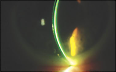 Figure 12. Central vault through the ordered 4,400 sagittal height lens OD of Case 2 patient.