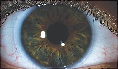 Figure 1. A poorly fit standard soft contact lens on a healthy ocular surface. See a video of this fit below.