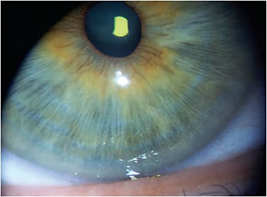 Figure 1. Example of a lower lid that is tangent to the lower limbus.
Image courtesy of Kyle Martin