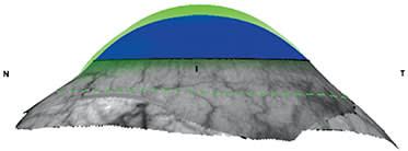 FIGURE 1. A prolate scleral lens fitted on an oblate cornea. The lens shows a high vault centrally while touching the peripheral cornea and limbus.Image courtesy of Gregory W. DeNaeyer, OD.