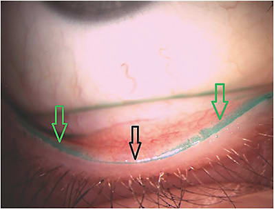 Figure 1. Mild lid wiper epitheliopathy (LWE) on the lower lid. The black arrow depicts the line of Marx, while the green arrows depict areas of LWE.